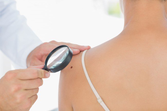 Caution: The number of moles on your arms can warn of skin cancer