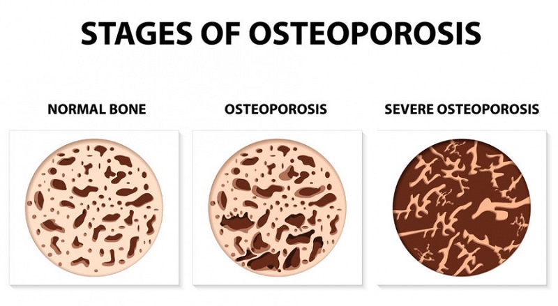 Do you suffer from osteoporosis? That’s what supplements to use!