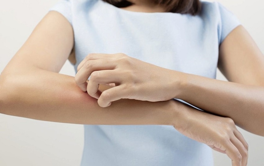 How to Successfully Deal With Troublesome Eczema